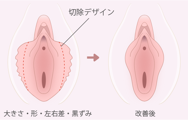 小陰唇縮小術